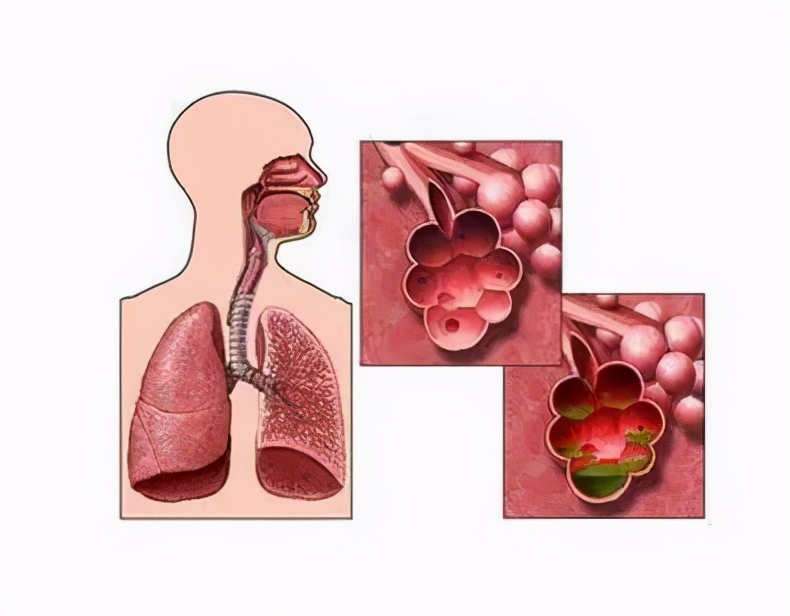 【健康科普】支气管炎的三大并发症！