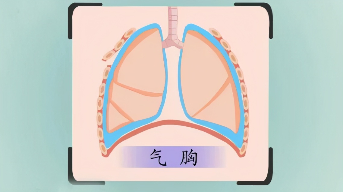 切莫忽视！哮喘病人都应该知道的哮喘六大并发症！