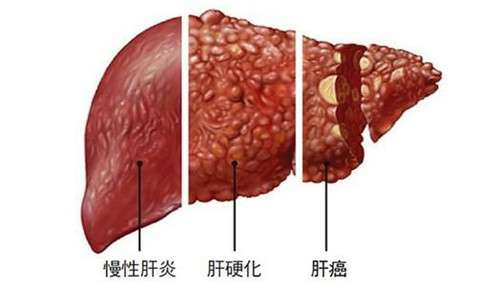 肝硬化还能活多久