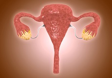 多囊卵巢综合征会不会引发不孕？