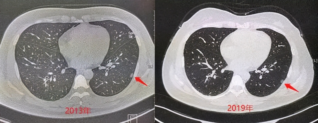 什么样的肺结节要及时干预，不然容易癌变？