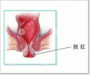 肛部处的“小肉球”能自己缩回去吗？