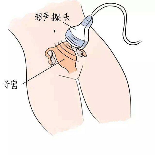 患了输卵管积水可以治好吗？