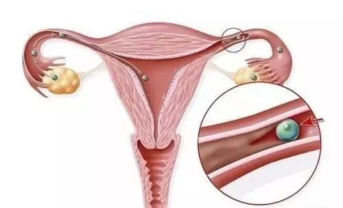 输卵管堵塞早有征兆,只是大部分女性都会忽视！