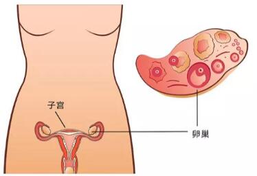 预防盆腔积液，快来看看~