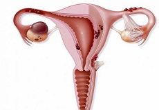 如何确定患上多囊卵巢？