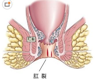 肛裂是怎么造成的？