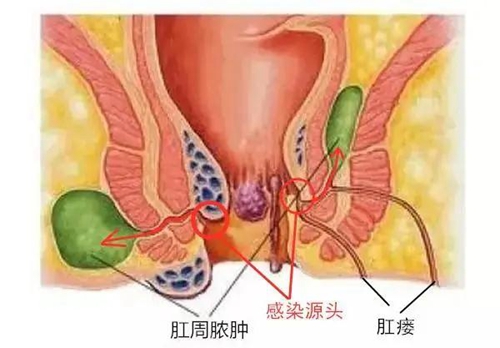 从疼痛类型判断可能是患了哪种肛肠疾病