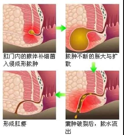 春季肛周脓肿突发怎么办？