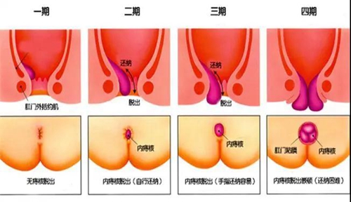 内痔“肉球”怎么收回去呢？