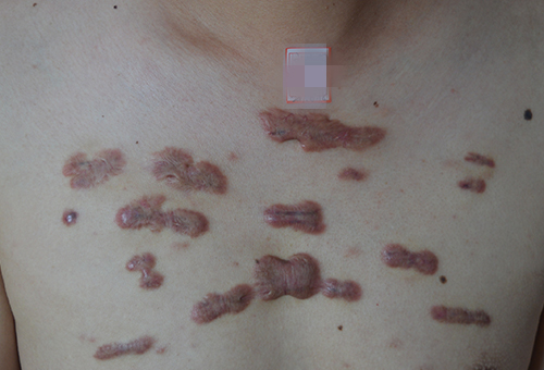 疤痕体质平时该怎么护理皮肤呢?
