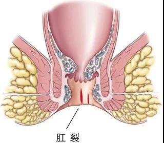 屁股痛就是上火？错！还可能是这7种肛肠问题