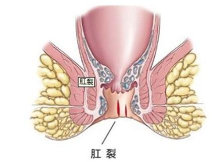 不只是痔疮会让肛部疼痛，肛裂也会！