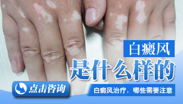 成都正规白癜风医院?详解手部白癜风的危害是怎样的?
