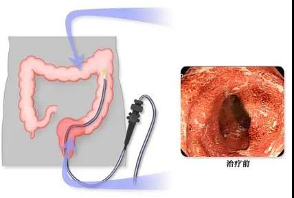肠镜 真没你想的那么可怕