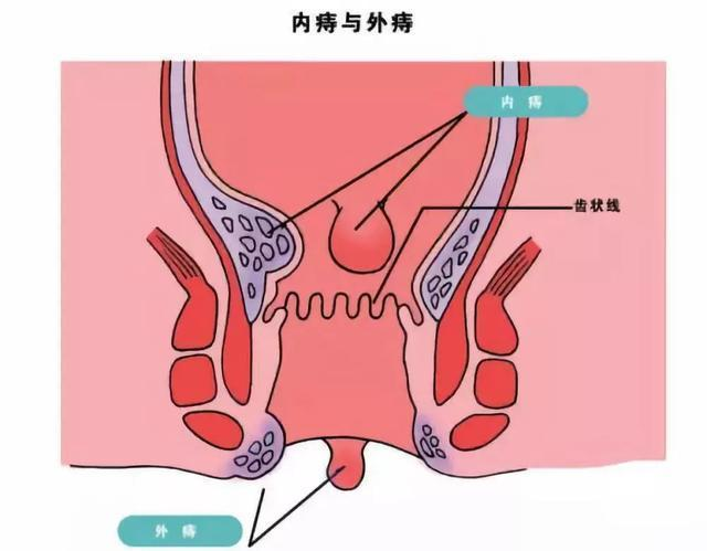 混合痔早期和晚期有什么不同？