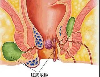 肛周脓肿来临前的“信号”有哪些？