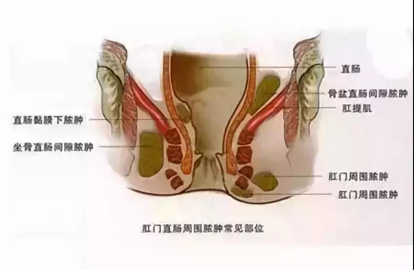 肛周脓肿的危害远比你想像的更可怕