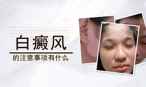 白癜风治疗禁忌有哪些