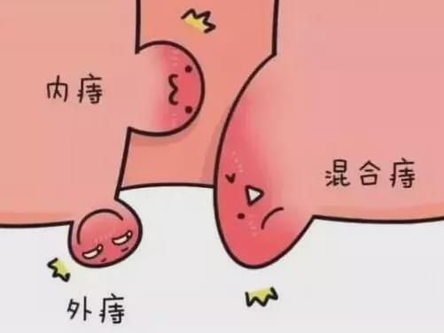 哪些症状与痔疮有关？
