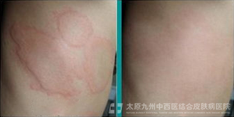 太原治疗皮肤病专业的医院？胆碱能性荨麻疹的临床表现？