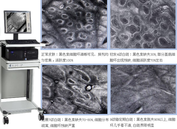 白癜风常识