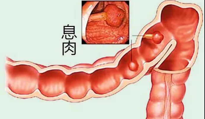 检查出结肠息肉，一定要切除吗？