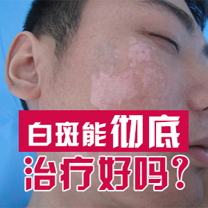 成都哪家医院白斑病好治？男性白癜风复发了怎么办