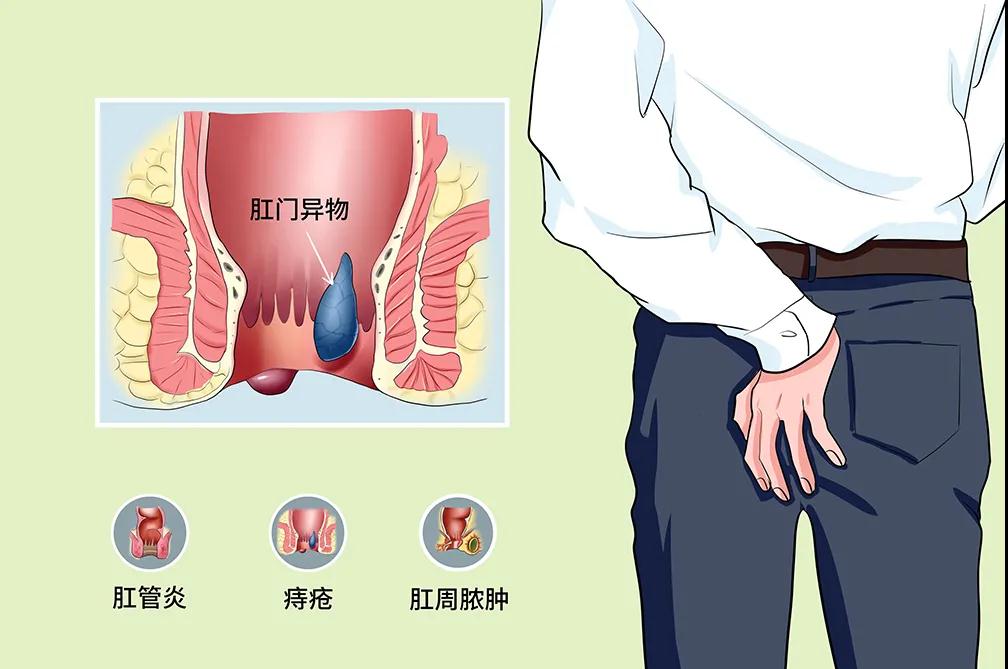 肛部总是有“异物感”别大意，可能与以下几种情况有关！