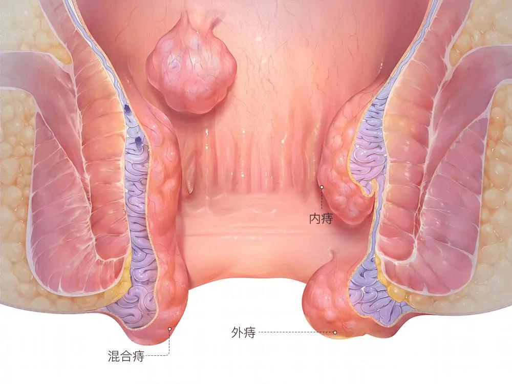 肛部处有分泌物如何自我判断？有哪些应急处理方法？