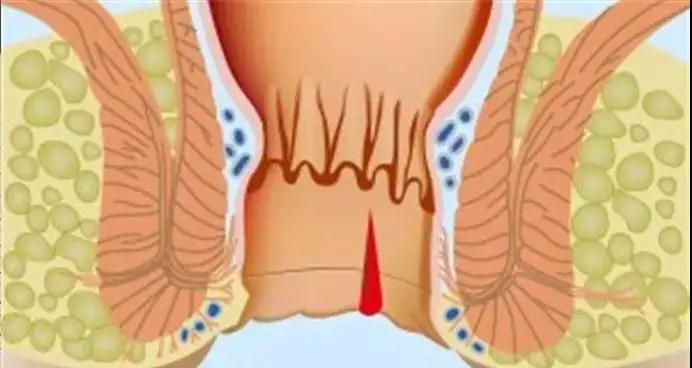 大便时肛部疼痛怎么回事？大多是疾病信号