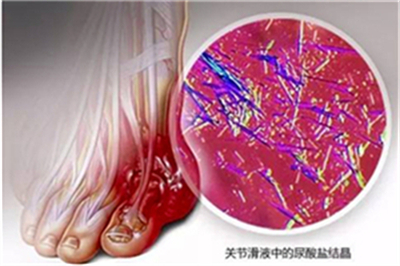 急性痛风的人可以喝白酒吗，贵州治疗痛风费用高不高