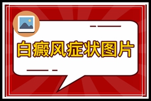 合肥治白癜风医院讲不同人群白斑初期怎么治