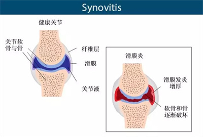 脚踝关节滑膜炎的好方法是什么