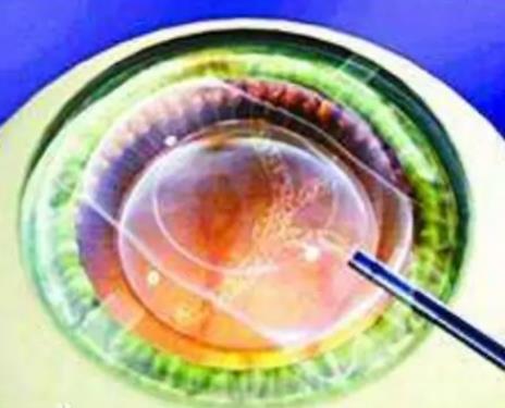 「揭密」ICL晶体植入术的费用比激光类手术贵的原因