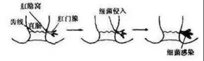 肛周脓肿破了会怎样？这个治疗误区容易犯