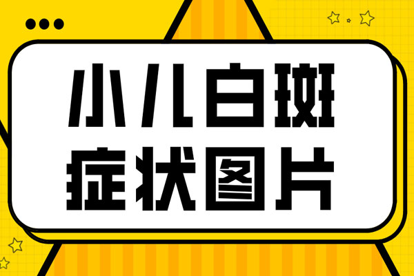 郑州什么样的白癜风专科医院能--小孩白斑