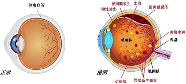 什么是视网膜新生血管？上海治疗视网膜病哪个医院好?