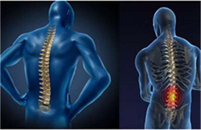 早起腰背部僵硬不適是強直性脊柱炎引起的