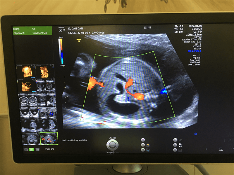 后怕！武汉仁爱医院四维彩超查出胎儿畸形