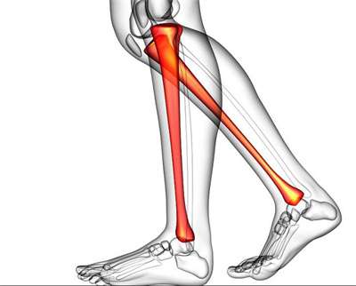 滑膜炎引起膝關節少量積液怎么辦呢