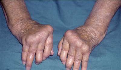 如何減輕類風濕性關節炎引起的手指腫痛呢