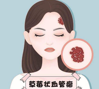 上海血管瘤的检查诊断的方法是什么？