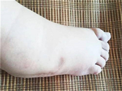 脚趾疼痛一定是痛风的症状，痛风可以吃什么药来迅速缓解疼痛呢