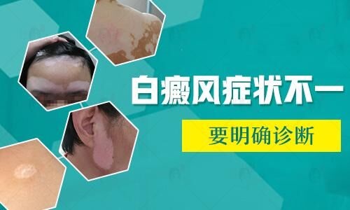 北京哪家医院治疗白癜风些？脸上的白斑是白癜风吗？