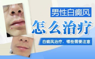 北京治疗白癜风较好的医院是哪家？男性脸上的白癜风怎么治疗呢？