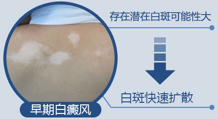治疗白癜风较好的北京专科医院？治疗白癜风的较佳季节是什么时候？