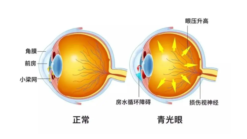 青光眼有哪些早期症状?西安哪些人容易患上青光眼?