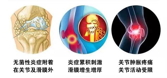 端午节风湿病抗复发管理分享交流会（第三季）在贵阳强直医院举办