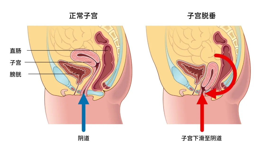 【大连美琳达医院】揭开产后2亿女性的狼狈！“背奶妈妈”变成“漏尿妈妈”的痛苦你也有么